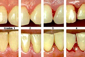 Gum Treatment and Whole Mouth Desinfection